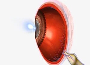 Cirrhosis of the Liver Eye